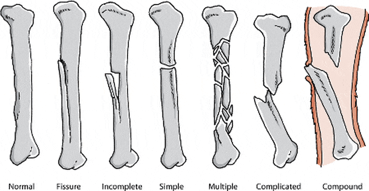 tipos de huesos rotos