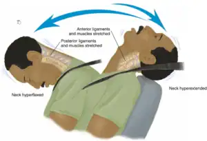 neck hyperflexed and hyperextended