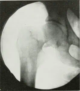shoulder injury lawyer image