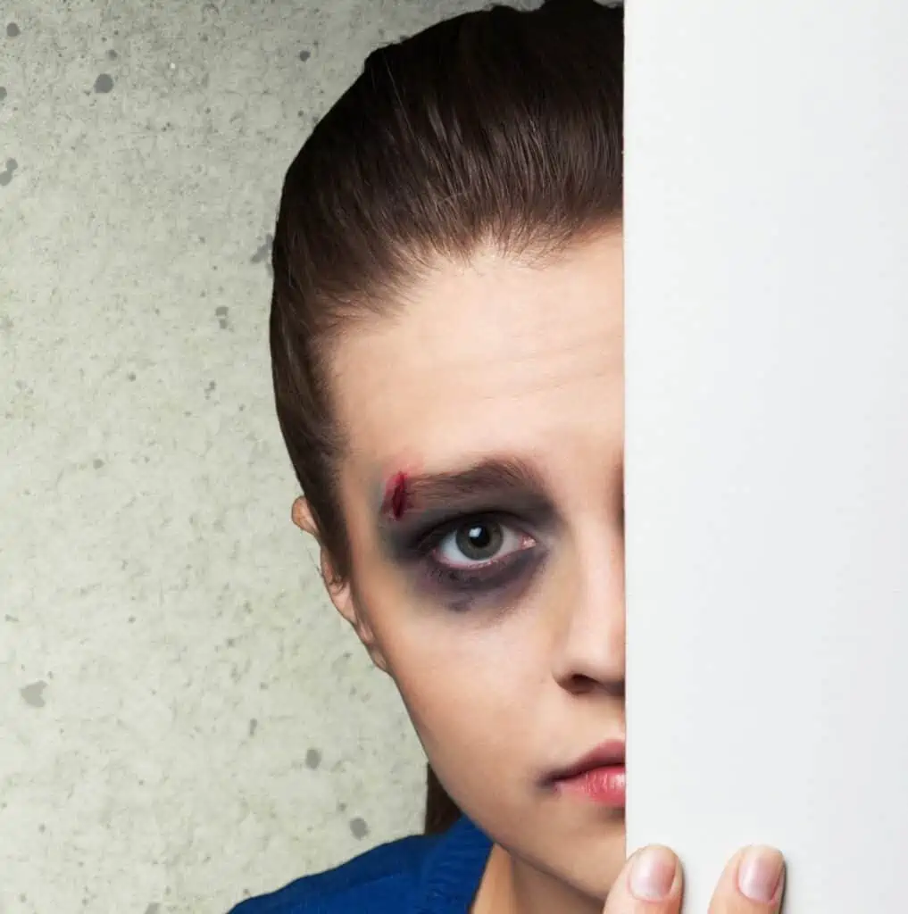 Woman with a bruised eye due to eye injury or loss