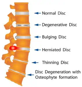 disc degeneration