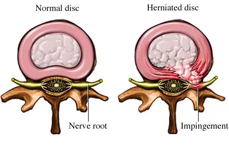 herniated disc