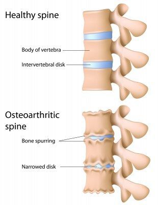 artritis espinal
