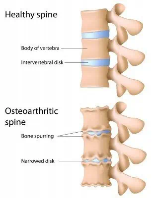 spinal arthritis