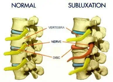 subluxation