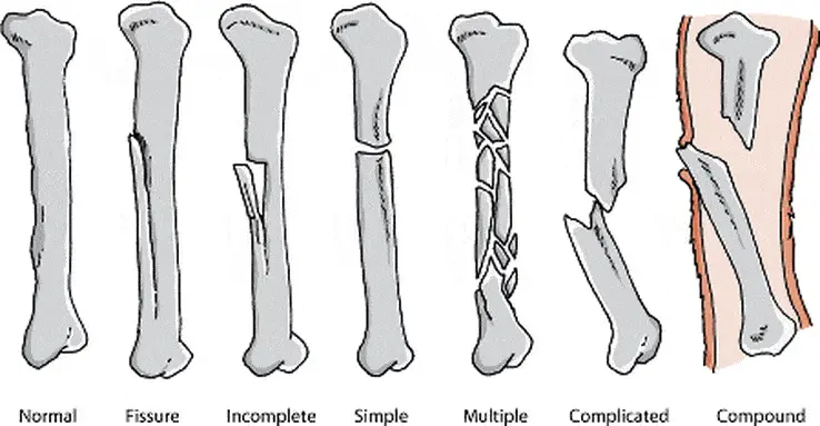 types of broken bones