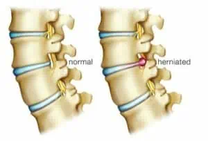 herniated disk image