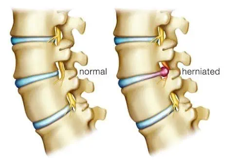 herniated disc image
