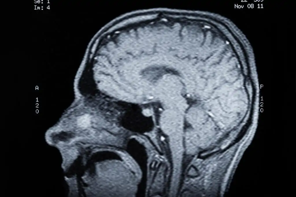 traumatic brain injury