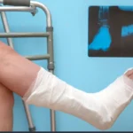 Bone fracture lawyer providing legal assistance for bone fracture injuries.