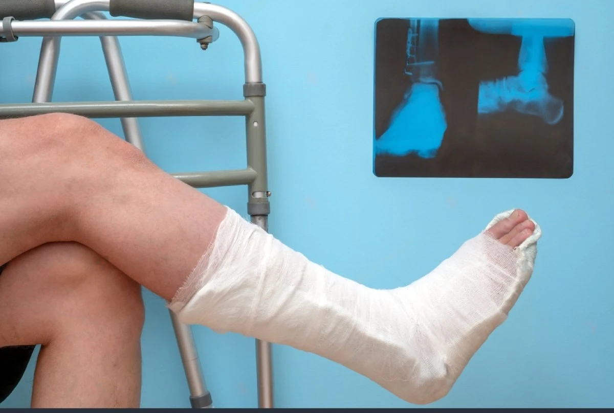 A man with a cast on a broken right foot seeking assistance from Austin bone fracture injury lawyers for legal assistance for bone fracture injuries.