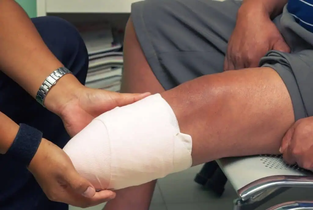 Illustration representing an amputation injury case, symbolizing the legal support an Austin amputation injury lawyer provides accident victims.