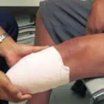 Illustration representing an amputation injury case, symbolizing the legal support an Austin amputation injury lawyer provides accident victims.